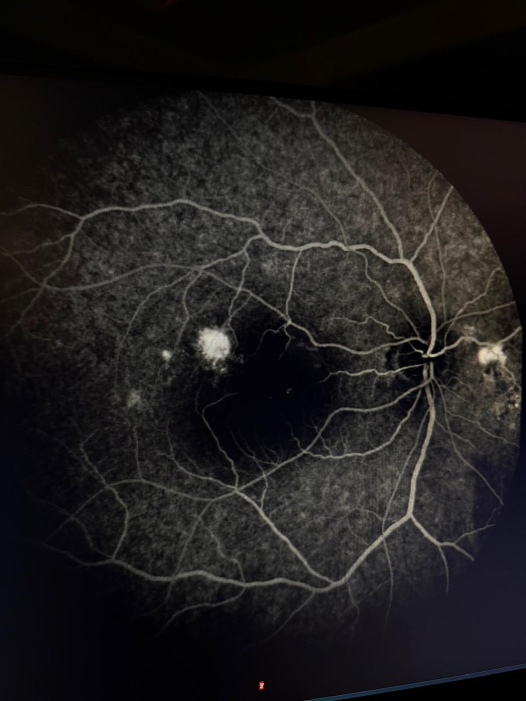 Fluorangiografia in corioretinopatia sierosa centrale, smokestack sign