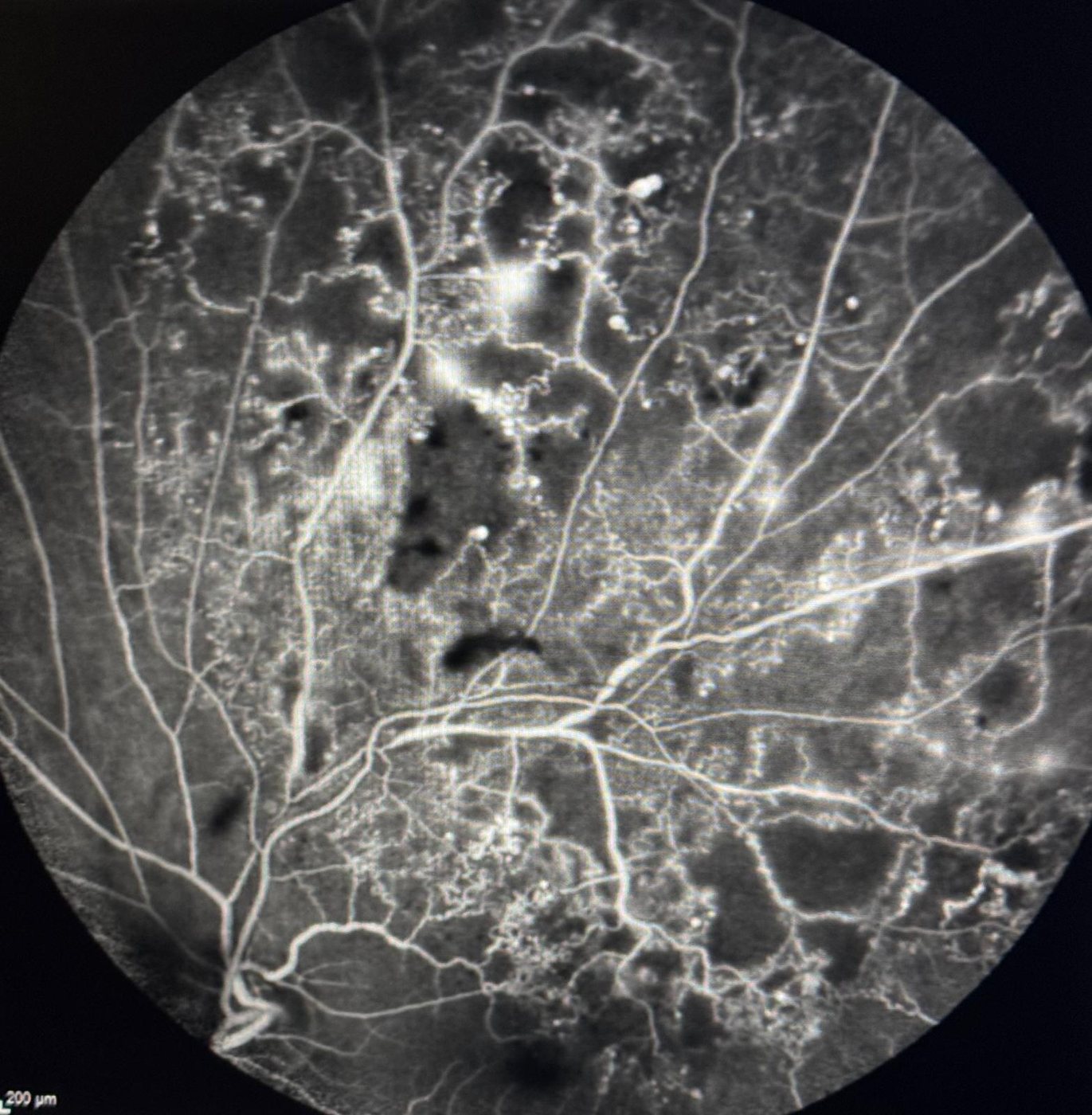 Fluorangiografia in occlusione venosa di branca