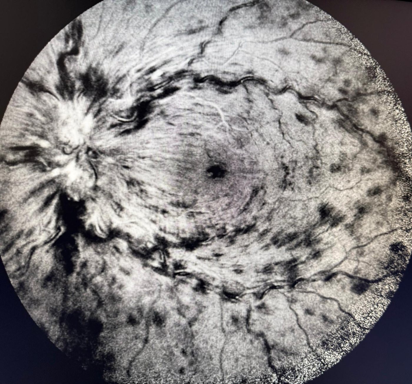 Fluorangiografia in occlusione della vena centrale della retina