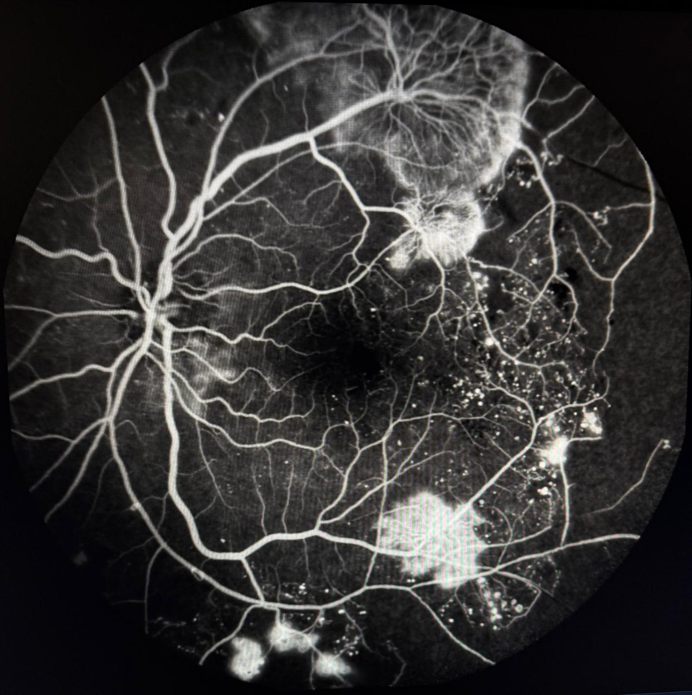 Fluorangiografia in retinopatia diabetica proliferante