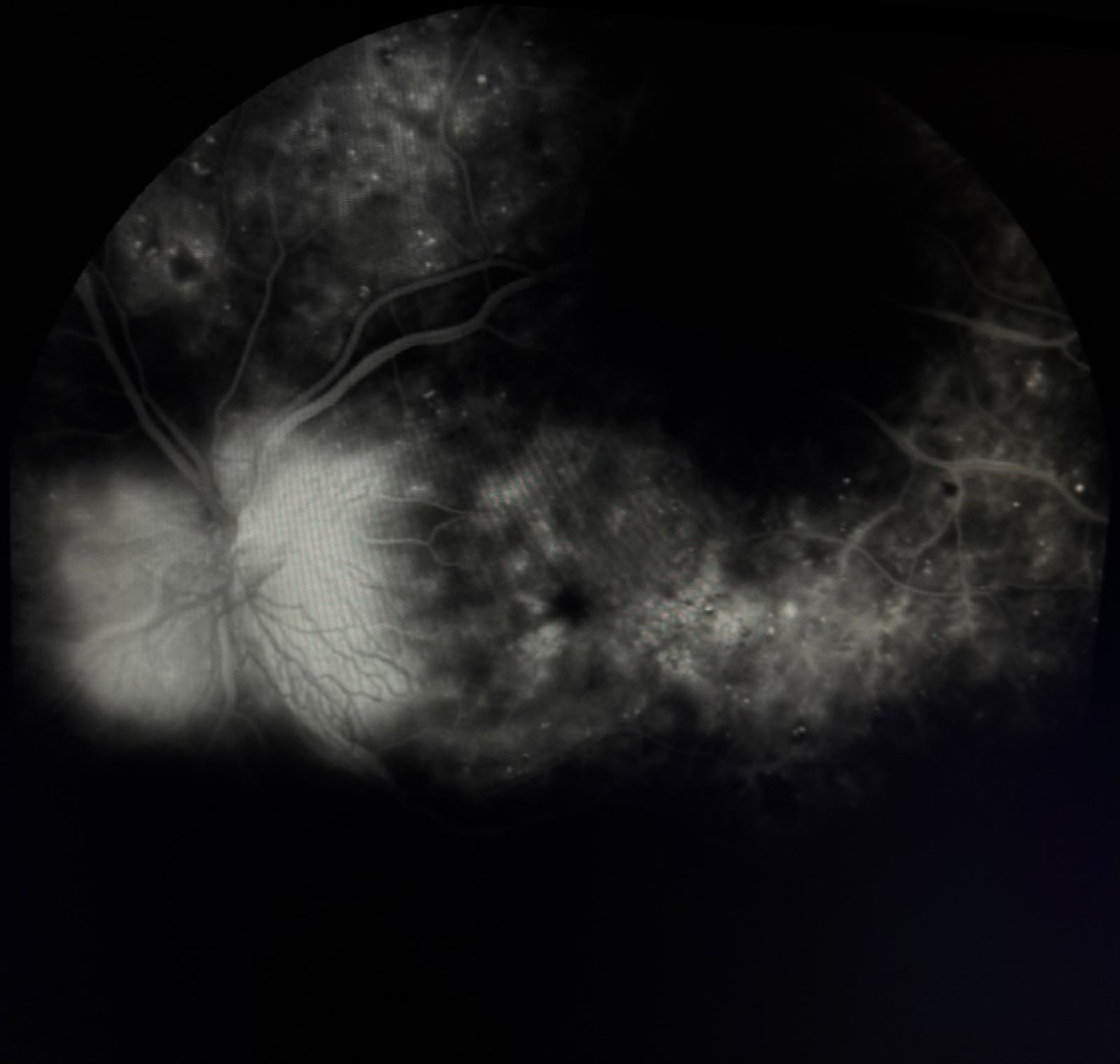 Fluorangiografia in retinopatia diabetica proliferante, neovasi