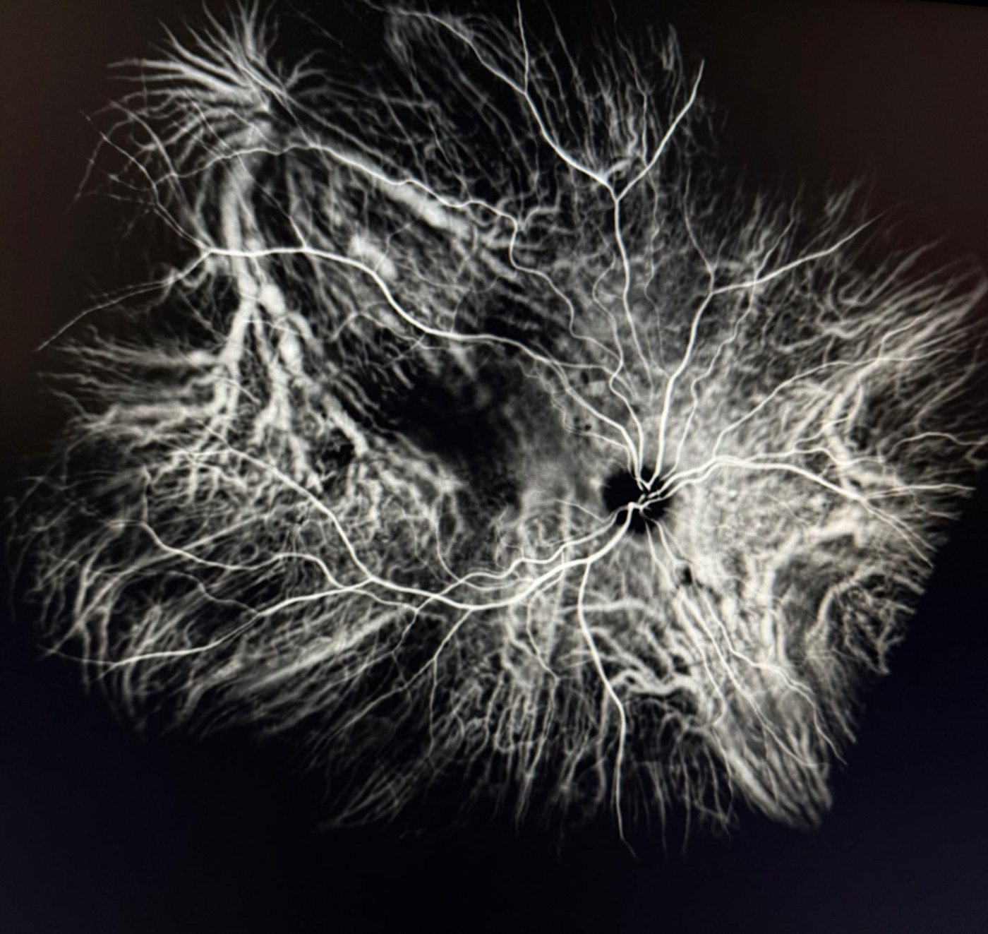 Angiografia al verde indocianina, epiteliopatia gravitazionale