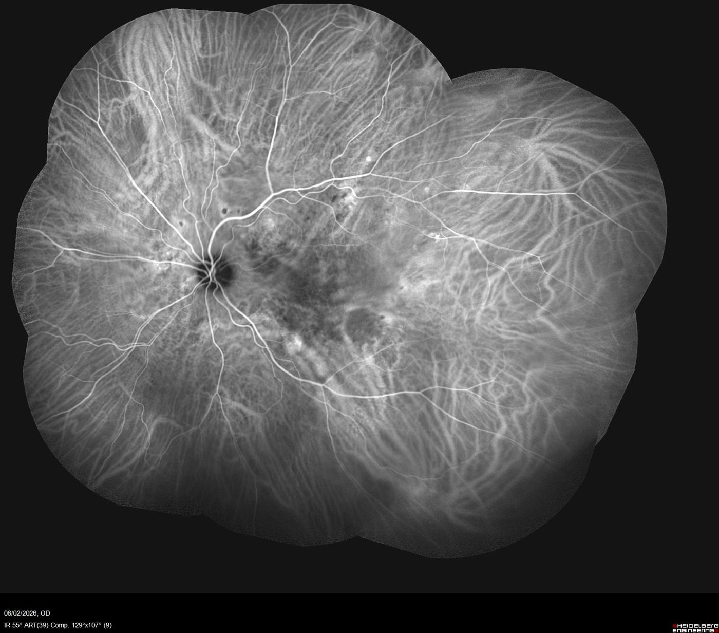 Angiografia al verde indocianina, dettaglio coroide