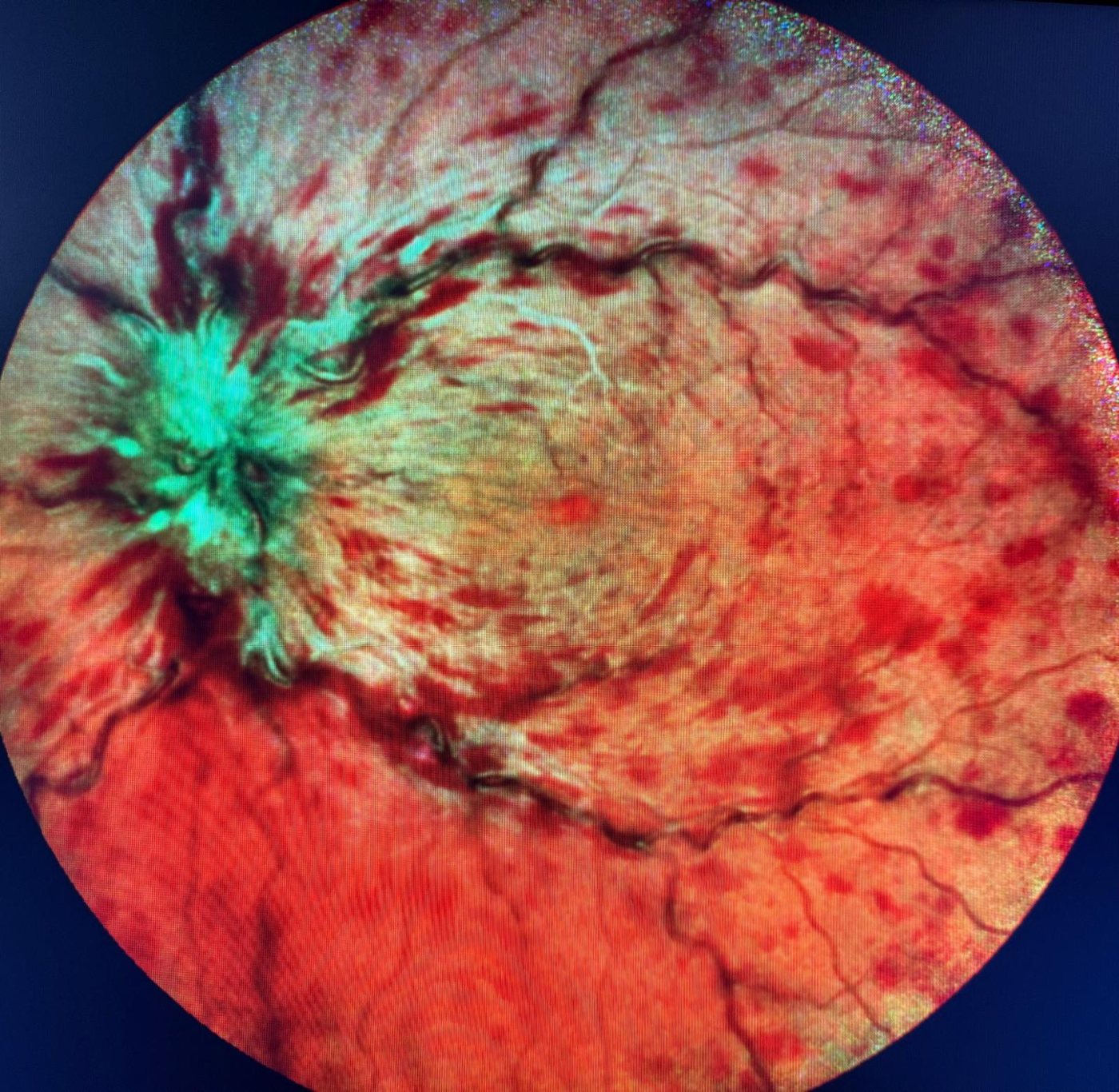 Immagine multicolor in occlusione della vena centrale della retina